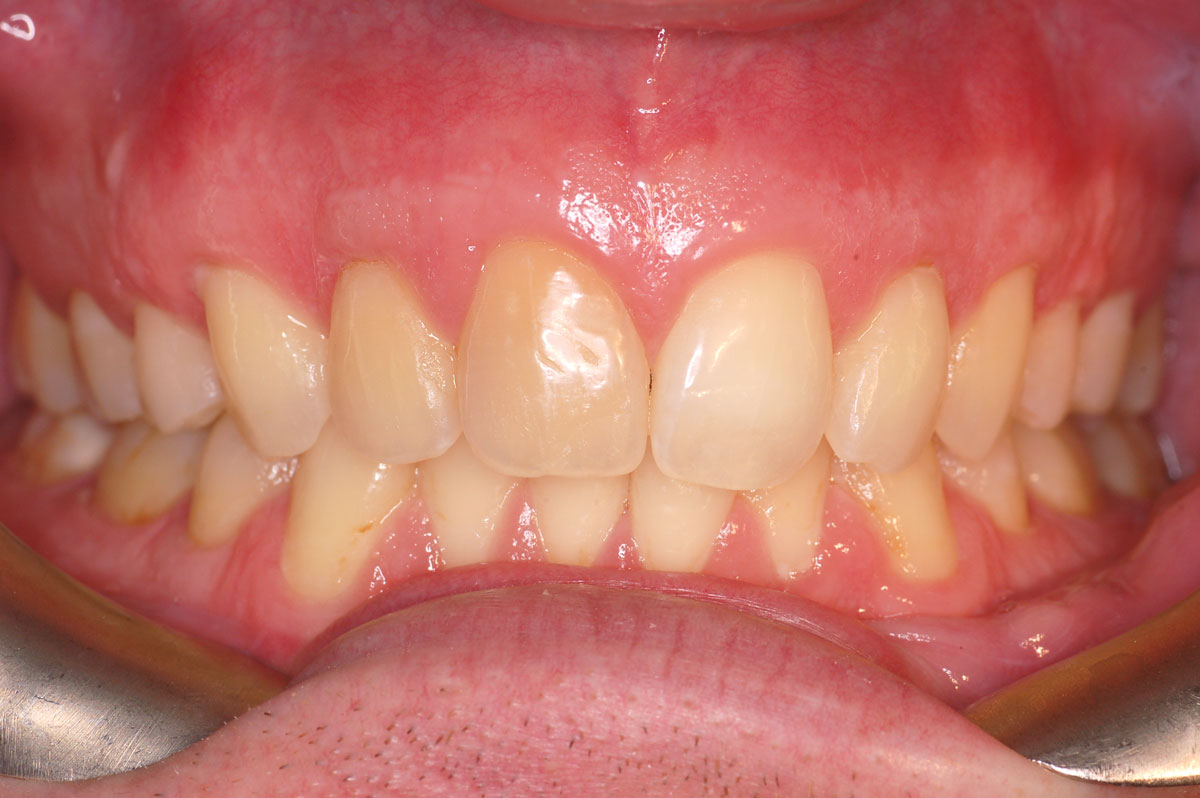 After Laser Gum Contouring New London, CT