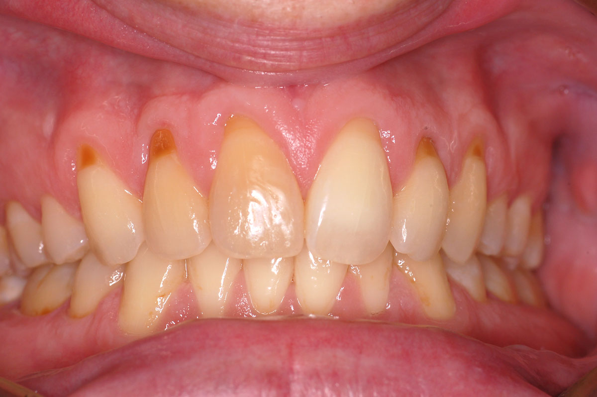 Laser gum contouring