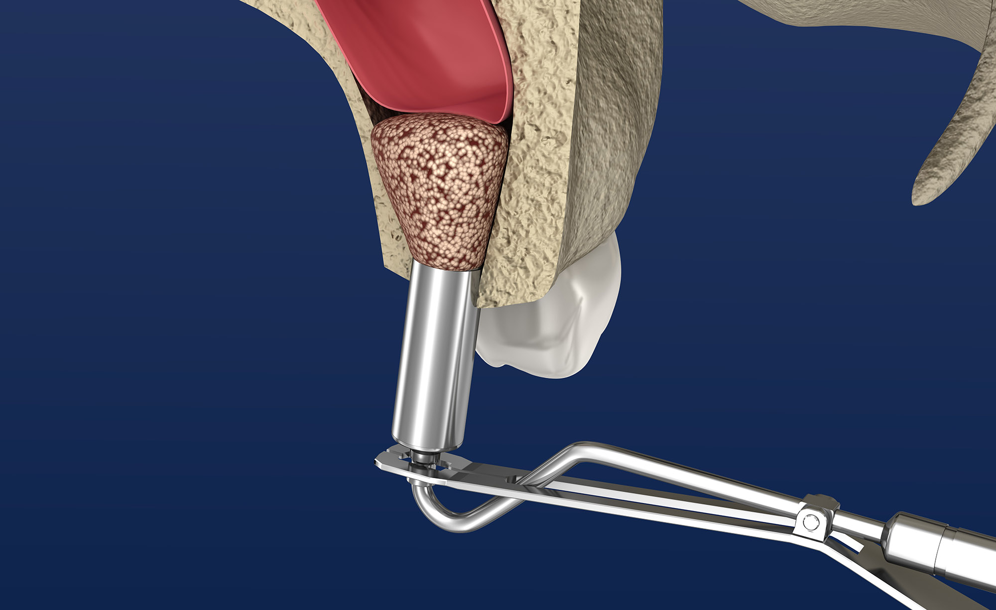 sinus-augmentation-new-london-ct-westerly-ri-shoreline