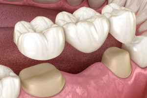 Dental Bridge Graphic