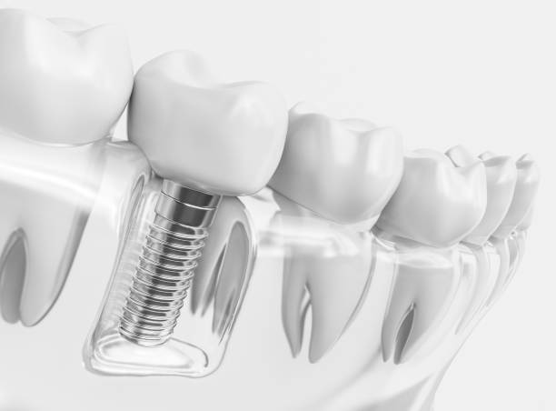 Tooth human implant.